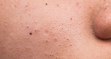 Blackheads