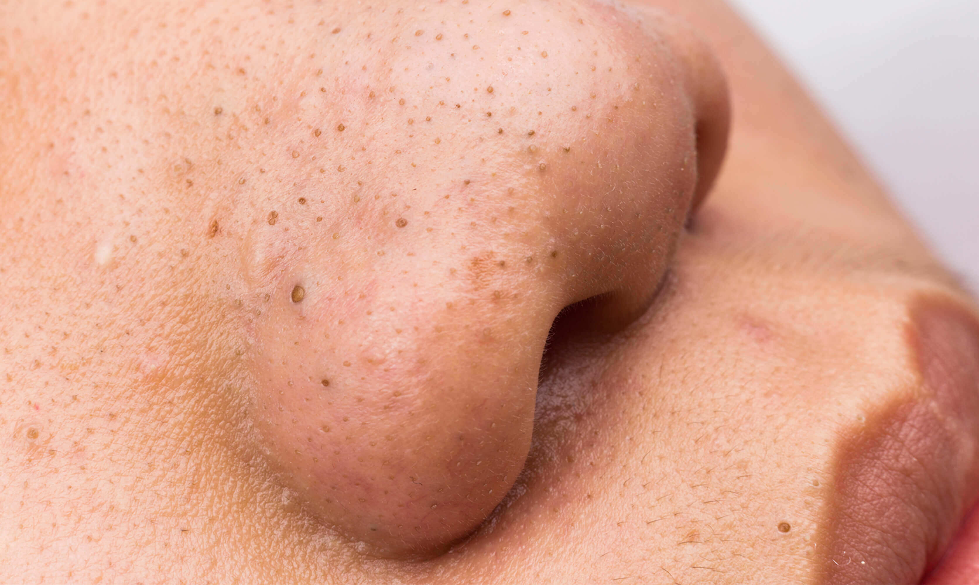 How to prevent blackheads