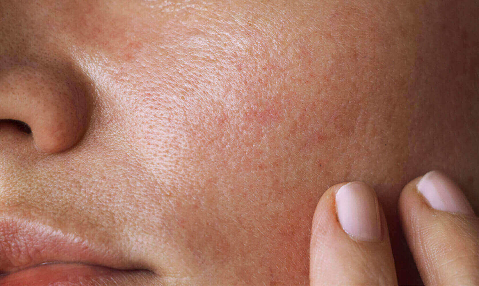What Causes Oily Skin? 