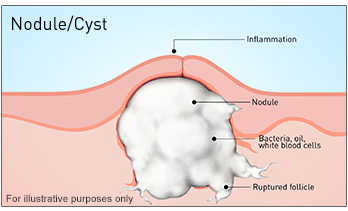 acne nodule vs cyst