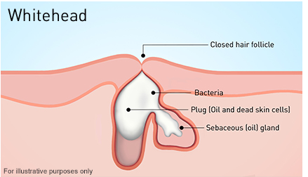 Whiteheads