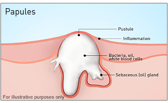 inside pimples