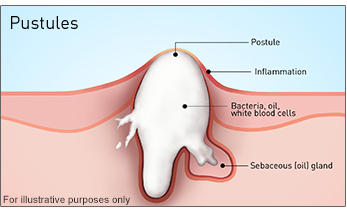 Pustules